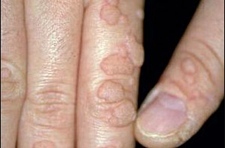 Как вывести бородавки Как вывести бородавки